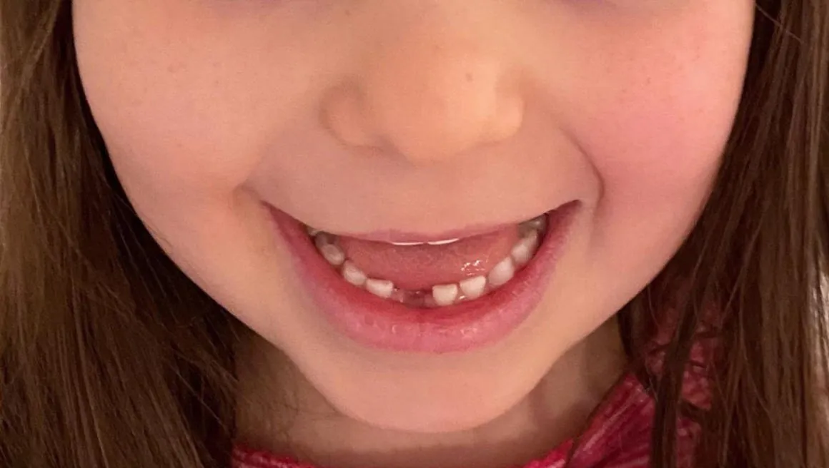 Bambina sorridente senza un dentino da latte