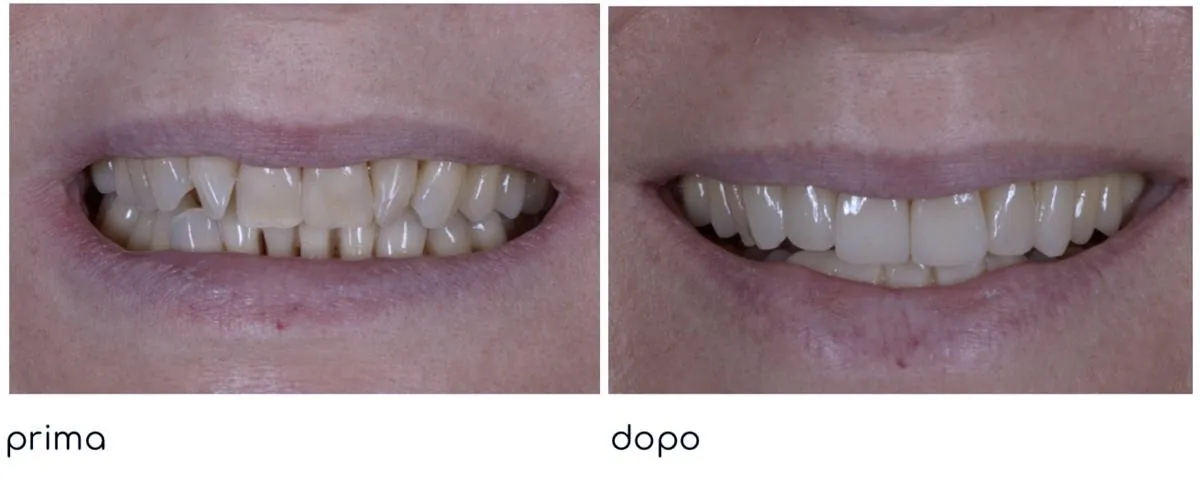 Sorriso prima e dopo le faccette