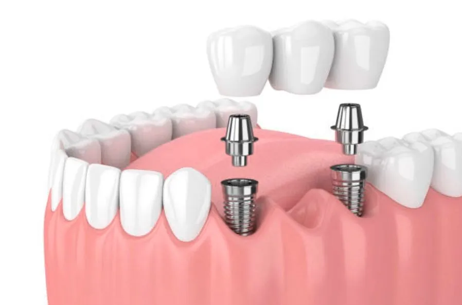 Impianto dentale con corona