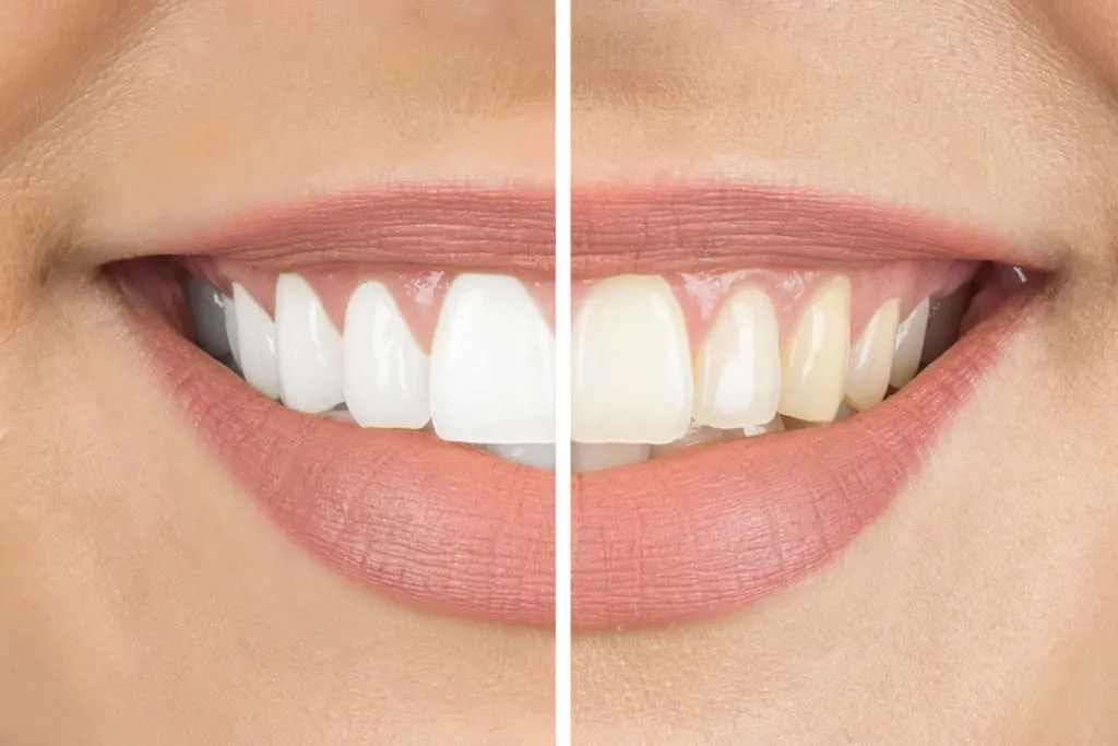Confronto del colore dei denti prima e dopo lo sbiancamento